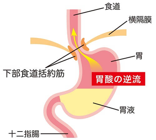 逆流性食道炎の原因